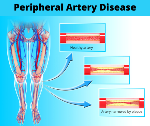 Ctvs Sheds Light On Peripheral Artery Disease