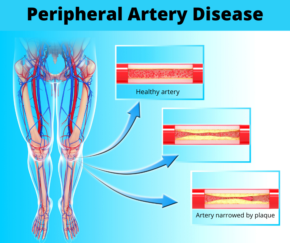 Disease peripheral artery Peripheral Arterial