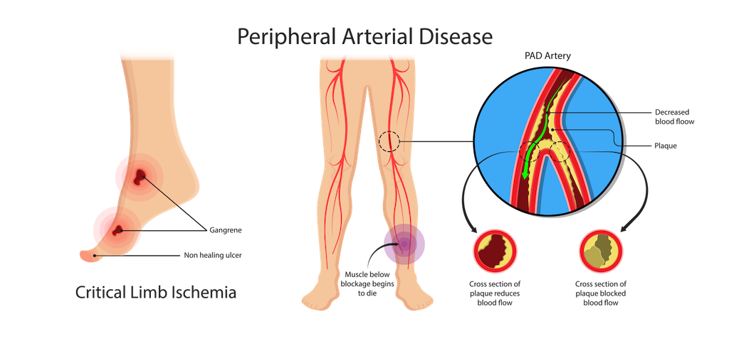 Peripheral vascular disease