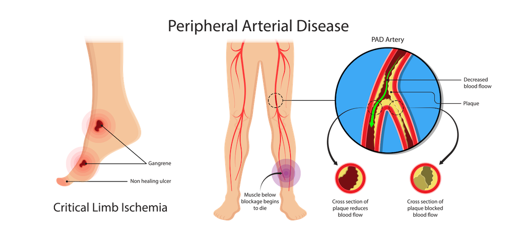 Pad symptoms shop