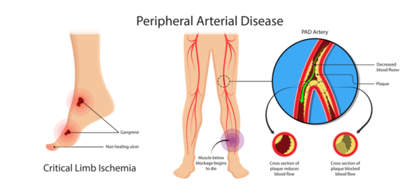 Amputation Prevention & Limb Preservation | CTVS Central Texas