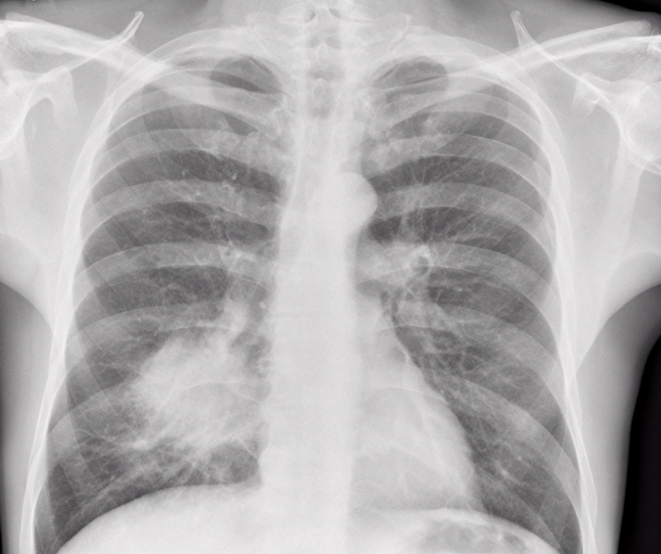 New Lung Cancer Screening Guidelines Could Save More Lives and Provide  Better Access